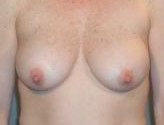 Patient # 40188 Before Photo # 1