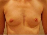 Patient # 86999 Before Photo # 1