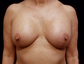 Patient # 24247 After Photo # 2