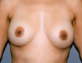Patient # 72440 After Photo # 2