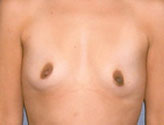 Patient # 72440 Before Photo # 1