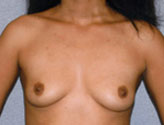 Patient # 92694 Before Photo # 1