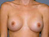 Patient # 86151 After Photo # 2