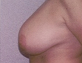 Patient # 43926 Before Photo # 3