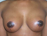 Patient # 67611 After Photo # 2