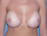 Patient # 44307 After Photo # 2