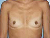 Patient # 86633 Before Photo # 1
