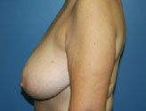 Patient # 89423 Before Photo # 1