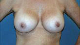 Patient # 33608 After Photo # 2