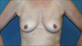 Patient # 33608 Before Photo # 1