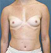 Patient # 61793 Before Photo # 1