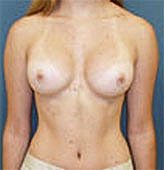 Patient # 61793 After Photo # 2