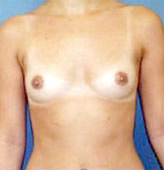 Patient # 12920 Before Photo # 1
