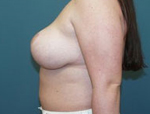 Patient # 56642 After Photo # 4