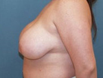 Patient # 56642 Before Photo # 3