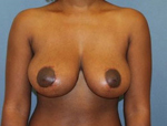 Patient # 26988 After Photo # 2