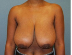 Patient # 26988 Before Photo # 1