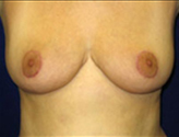 Patient # 57541 After Photo # 2