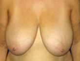 Patient # 57541 Before Photo # 1
