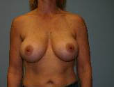 Patient # 33598 After Photo # 2