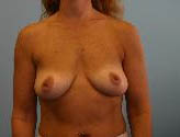 Patient # 33598 Before Photo # 1