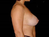 Patient # 76025 After Photo # 4