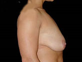Patient # 76025 Before Photo # 3