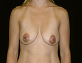 Patient # 20773 Before Photo # 1