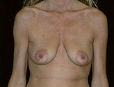 Patient # 69537 Before Photo # 1