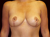 Patient # 43068 After Photo # 2