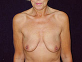 Patient # 19761 Before Photo # 1