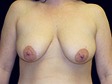 Patient # 51902 Before Photo # 1