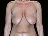 Patient # 66959 Before Photo # 1