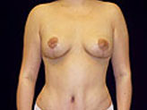 Patient # 39131 After Photo # 2