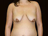 Patient # 39131 Before Photo # 1