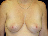 Patient # 42336 After Photo # 2
