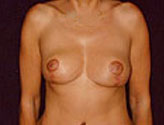 Patient # 14272 After Photo # 2