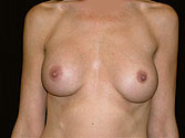 Patient # 20518 Before Photo # 1