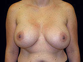 Patient # 22972 After Photo # 2