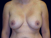 Patient # 22972 Before Photo # 1