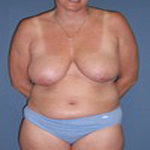 Patient # 25785 Before Photo # 1