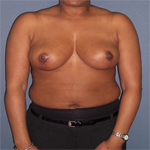 Patient # 49735 After Photo # 2