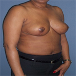 Patient # 49735 After Photo # 4