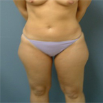 Patient # 69631 Before Photo # 1