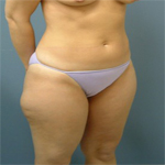 Patient # 69631 Before Photo # 3