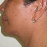 Patient # 87552 After Photo # 2