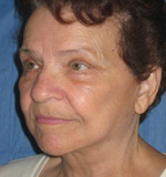 Patient # 16537 After Photo # 2