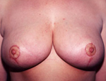 Patient # 90537 After Photo # 2