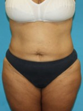Patient # 24317 After Photo # 2