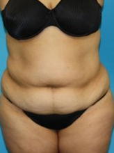 Patient # 24317 Before Photo # 1
